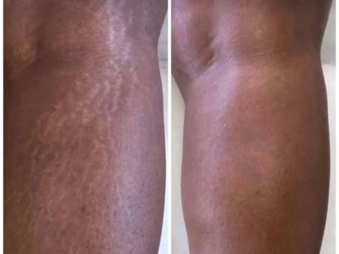 Stretch Mark Oil